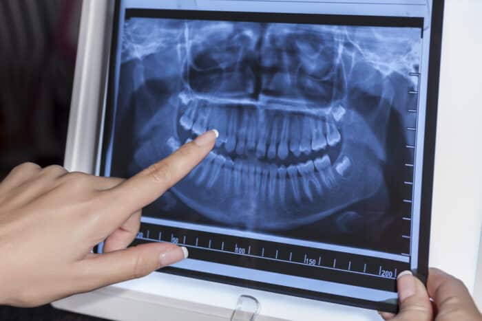  dental x-rays.